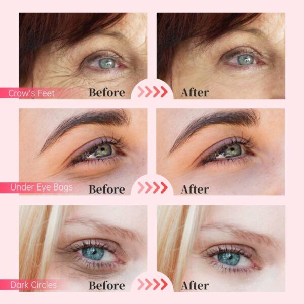 PARCHES PARA LAS OJERAS ILUMINADORES